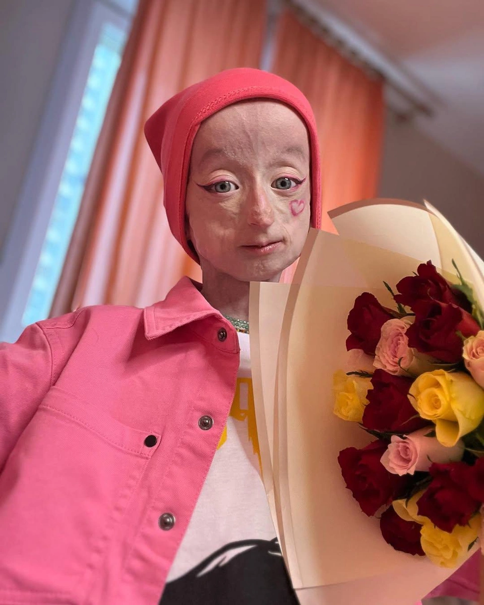 progeria1-1773850832.webp